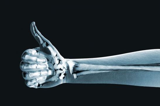Х-зраци за дијагностицирање на болка во зглобовите на прстите