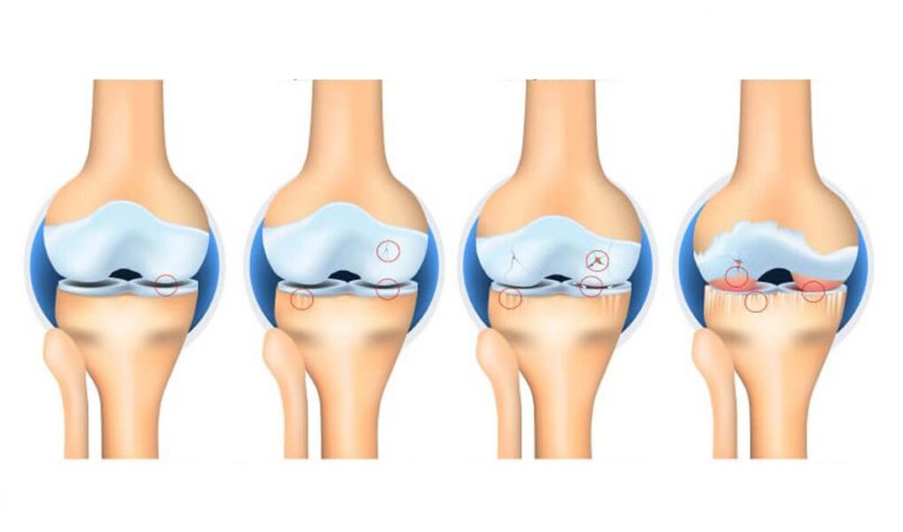 фази на артроза на коленото зглоб