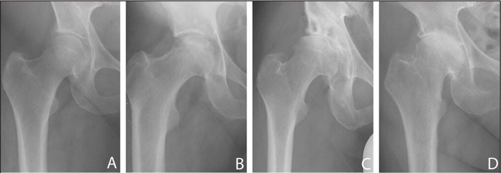 Фази на развој на артроза на зглобот на колкот на рентген