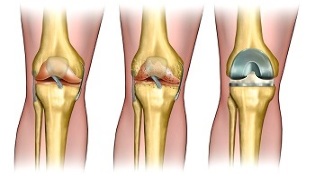 ендопротетика за артроза на колен зглоб